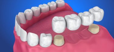 Dental-crown-and-Bridge-768x476.jpg.optimal Dental-crown-and-Bridge-768x476.jpg.optimal