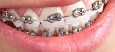 orthodontic-braces orthodontic-braces