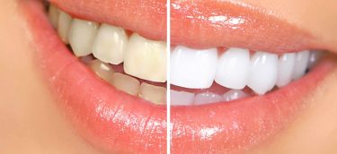 teeth-whitening-1 teeth-whitening-1