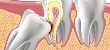 wisdom-tooth-removal-montreal-maxillovendome wisdom-tooth-removal-montreal-maxillovendome